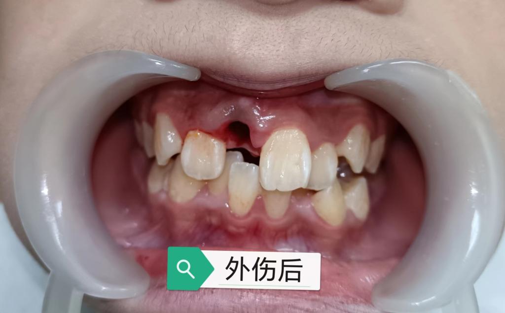 牙齒意外損傷脫落該怎么辦？