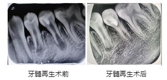 我院口腔醫院開展牙髓血管再生術