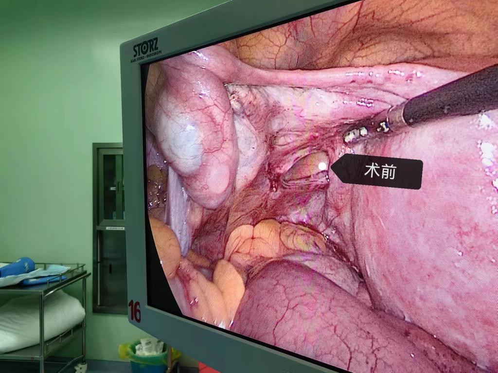 這樣的“腸梗阻”你能想到是腹內疝嗎？