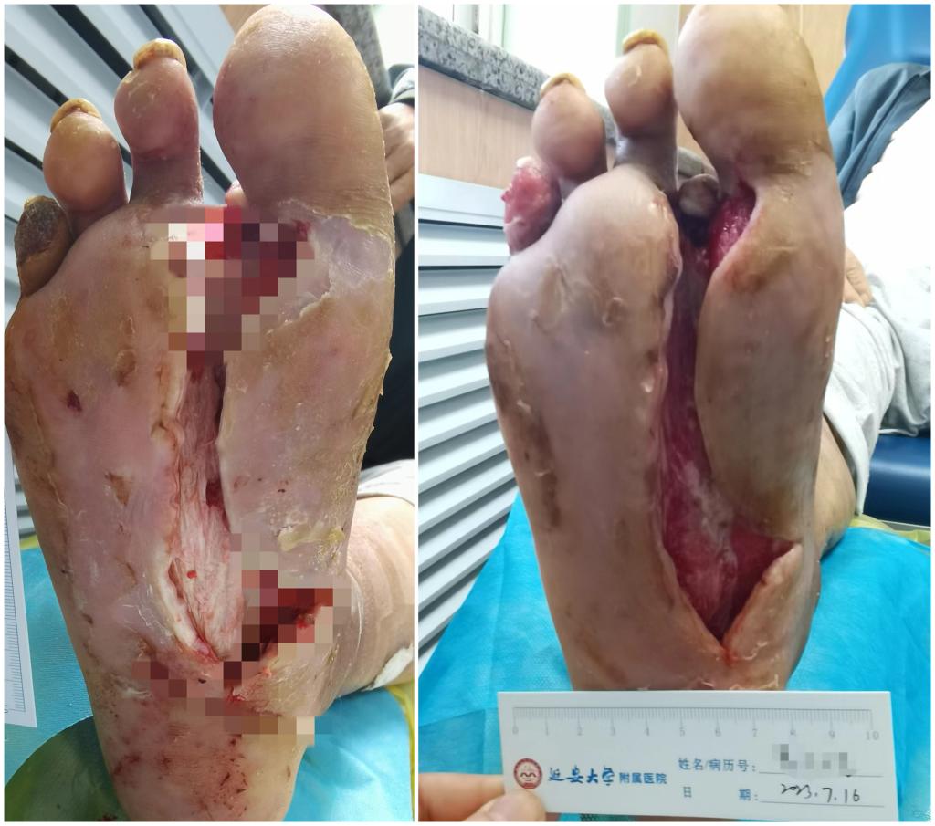 【絕處逢生】曹大爺的腳保住了！
