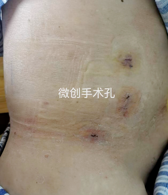 我院胃腸疝外科開展首例經(jīng)后腹腔鏡腰疝全腹膜外修補(bǔ)術(shù)（R-TEP）