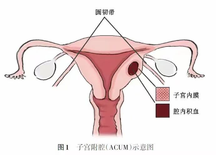 我院婦科成功解開17歲少女四年病痛之謎