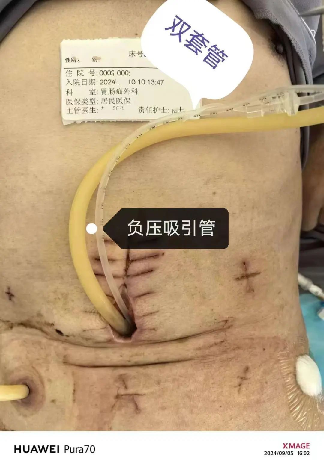雙管齊下 解決“瘺”洞