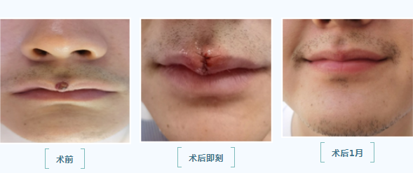 口腔頜面外科 美容縫合 還您美麗容顏