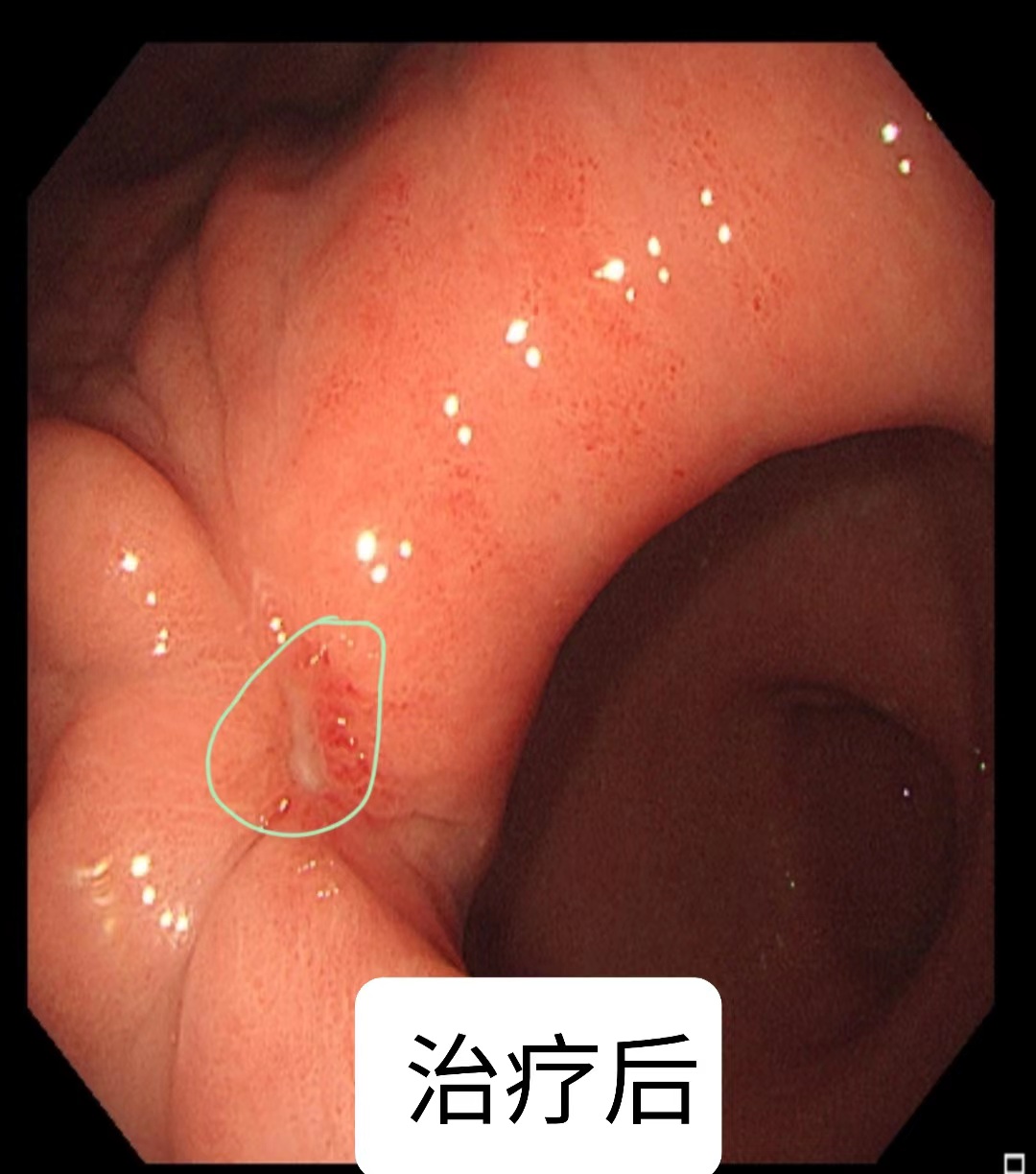 一例胃腫瘤神奇療效而帶來的喜悅