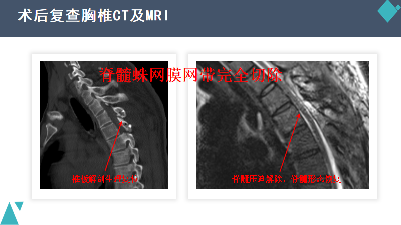 我院完成首例罕見的脊髓蛛網膜網帶切除術
